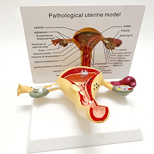 Uterus & Eierstock Pathologisches Modell Human Uterus Modell, krankes Uterus-Modell for Ärzte Büro Pädagogisches Werkzeug Uterus & Eierstock Pathologisches Modell Human Uterus Modell, krankes Uterus-Modell for Ärzte Büro Pädagogisches Werkzeug von ATJOGWIN