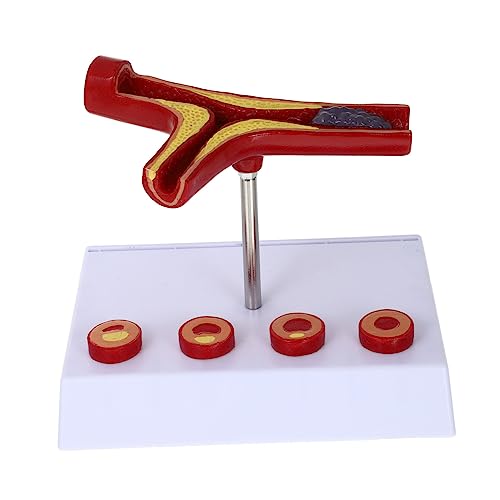 Amosfun Atherosklerose Anatomisches Modell aus Blutgefäß Modell für Medizinische Ausbildung Langlebig Realistisch für Anschaulichen von Amosfun