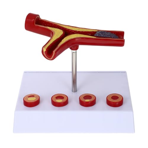 BUGUUYO Atherosklerose Anatomisches Modell Realistisches Blutgefäß Modell für Medizinische Ausbildung Geeignet für Universitäten und Hochwertiges Langlebig BUGUUYO Atherosklerose Anatomisches Modell Realistisches Blutgefäß Modell für Medizinische Ausbildung Geeignet für Universitäten und Hochwertiges Langlebig von BUGUUYO