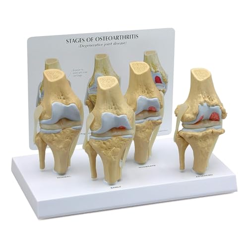 Osteoarthritisches Kniemodell, Anatomiemodell for degenerative Gelenkerkrankungen for Arztpraxen und Klassenzimmer Osteoarthritisches Kniemodell, Anatomiemodell for degenerative Gelenkerkrankungen for Arztpraxen und Klassenzimmer von CHENHOJU
