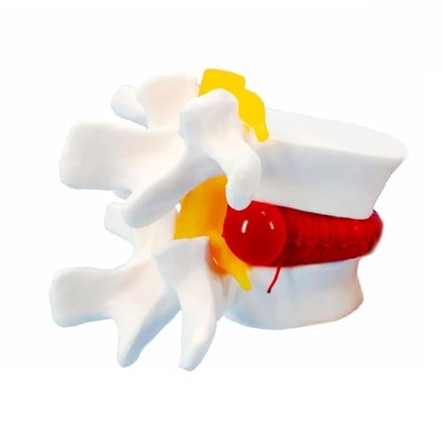 Skelettmodell Vergrößerter Lendenwirbelscheibenvorfall, anatomisches Modell, bewegliche menschliche Lendenwirbelsäule zum Unterrichten und Lernen Skelettmodell Vergrößerter Lendenwirbelscheibenvorfall, anatomisches Modell, bewegliche menschliche Lendenwirbelsäule zum Unterrichten und Lernen von CHENHOJU
