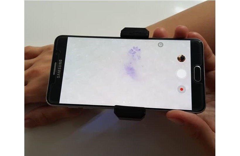 Handyscope Dermatoscope Digital Dermoscopy Haut Diagnose Krätze Skabies Erkennen von Etsy - Innovationmed