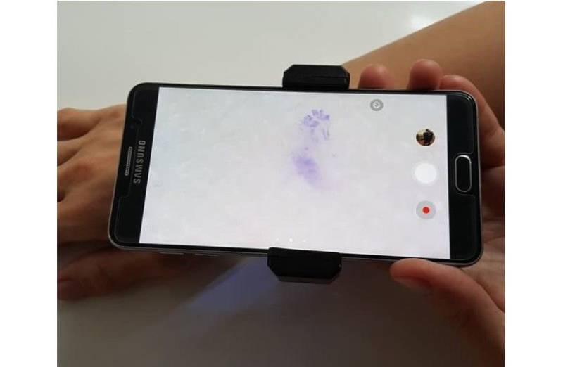 Handyscope Dermatoscope Digital Dermoscopy Haut Diagnose Krätze Skabies Erkennen von Etsy - Innovationmed