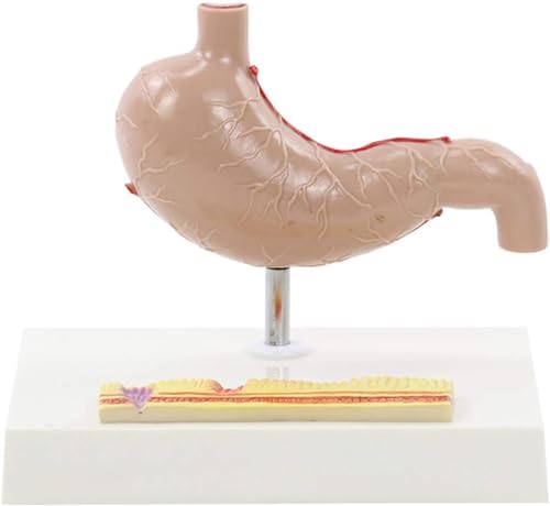 Magenperforation, Magenanatomie, Pathologisches Modell, Gastroenterologie, Menschliches Magenanatomiemodell, Menschliches Magenläsionsmodell, Anatomisches Pathologisches Pathologisches Magenmodell Magenperforation, Magenanatomie, Pathologisches Modell, Gastroenterologie, Menschliches Magenanatomiemodell, Menschliches Magenläsionsmodell, Anatomisches Pathologisches Pathologisches Magenmodell von FYYYSLKX