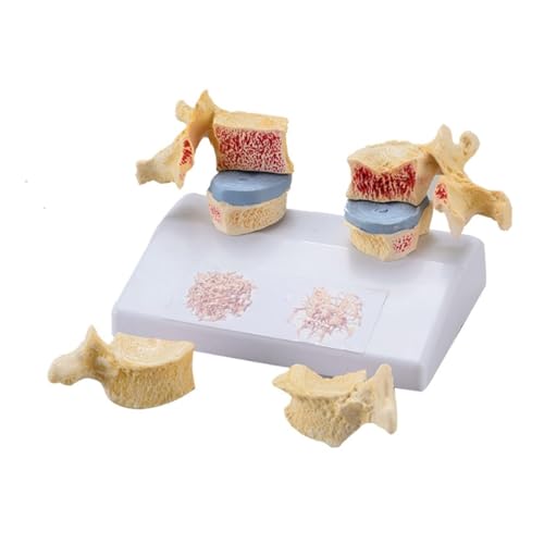 Menschliches Skelett-Osteoporose-Läsionsmodell, Demonstrationsmodell for osteoporotische Läsionen der Wirbelsäule und der Halswirbel von FYYYSLKX