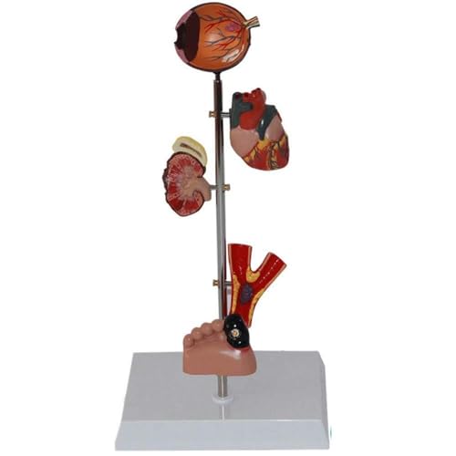 Organmodell Des Menschen Diabetes-Modell Des Menschen – Auge Niere Herz-Kreislauf-Modell Fußmodell (mit 5 Beweglichen Teilen) Inklusive Einfachem Ausstellungsständer Diabetes-Modell Des von FYYYSLKX
