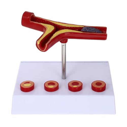 GLEAVI Atherosklerose Anatomisches Modell Medizinisches Blutgefäßmodell Für Kardiovaskuläre Ausbildung Humanes Atherosklerose Display Modell Für Krankenhäuser Und Lehrzwecke GLEAVI Atherosklerose Anatomisches Modell Medizinisches Blutgefäßmodell Für Kardiovaskuläre Ausbildung Humanes Atherosklerose Display Modell Für Krankenhäuser Und Lehrzwecke von GLEAVI
