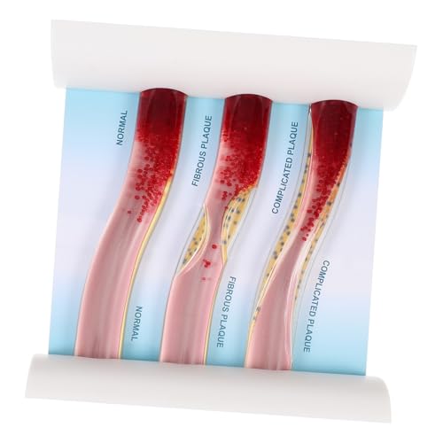 HEALSOPTHY Anatomisches Blutgefäßmodell aus Dynamisches Ldl Arterien und Venenmodell Medizinisches Lehrmodell für Studenten und Ärzte Anschauliche Darstellung der Gefäßschäden HEALSOPTHY Anatomisches Blutgefäßmodell aus Dynamisches Ldl Arterien und Venenmodell Medizinisches Lehrmodell für Studenten und Ärzte Anschauliche Darstellung der Gefäßschäden von HEALSOPTHY