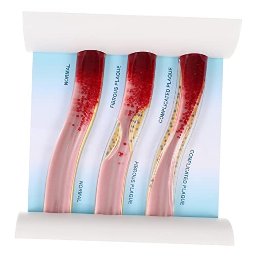 Holibanna Anatomisches Blutgefäßmodell aus Modell zur Medizinischen Ausbildung für Medizinstudenten Fachkräfte zur Simulation Gesunder Erkrankter Blutgefäße Holibanna Anatomisches Blutgefäßmodell aus Modell zur Medizinischen Ausbildung für Medizinstudenten Fachkräfte zur Simulation Gesunder Erkrankter Blutgefäße von Holibanna