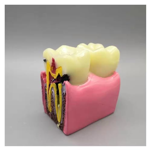 1 Pc Dental Materialien Labor Zähne Modell 6 Mal Karies Vergleich Studie Modelle for Zahnarzt Studieren Und Forschen 1 Pc Dental Materialien Labor Zähne Modell 6 Mal Karies Vergleich Studie Modelle for Zahnarzt Studieren Und Forschen von Huhpa