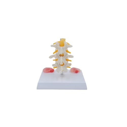 1 Satz Lendenwirbel mit Hernie und Bandscheibenvorfall Modelle Lendenskelett Anatomisches Modell Lehrmittel von Huhpa
