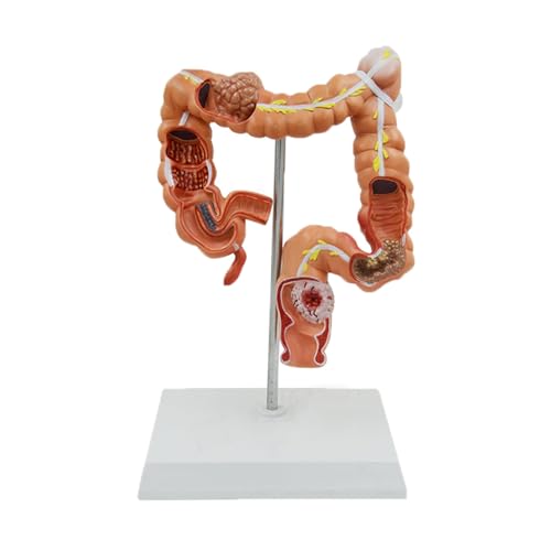 1 Stück Anatomisches Modell des menschlichen Dickdarms, viszerale Läsionsmodell, wissenschaftliche Lehrressourcen von Huhpa