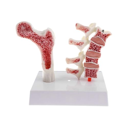11 Satz Lebensgroße Menschliche Lendenwirbel Femur Osteoporose Modell Deluxe Traumatische Pistole Medizinische Skelett Trauma Anatomie Instrumente von Huhpa