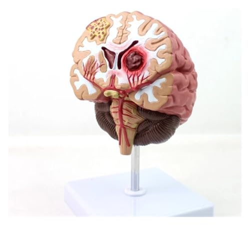 1pc 1:1 Menschen Gehirn Krankheit Modell Gehirn Anatomisches Modell Neurochirurgie Gehirn Blutung Gehirn Pathologische Medizinische Lehr Modell von Huhpa