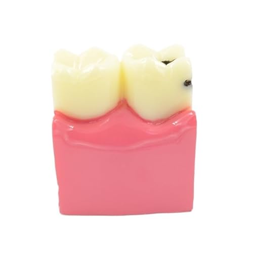 1pc Dental Materialien Labor Zähne Modell 6 Mal Karies Vergleich Studie Modelle for Zahnarzt Studieren Und Forschen von Huhpa