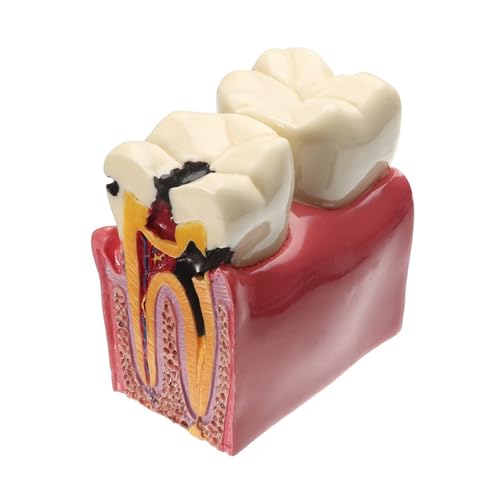 1pc Dental Zähne Modell Karies Vergleich Studie Prothese Zahn Modelle Zahnarzt Studieren Und Erforschen Zahnmedizin Liefert von Huhpa