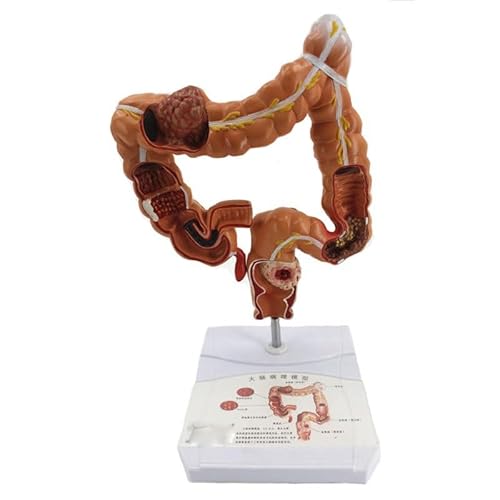 1pc Kolon Pathologie Modell Dickdarm Modell Kolorektale Läsion Modell Darm Krankheit Menschlichen Dickdarm Läsion Modell 1pc Kolon Pathologie Modell Dickdarm Modell Kolorektale Läsion Modell Darm Krankheit Menschlichen Dickdarm Läsion Modell von Huhpa