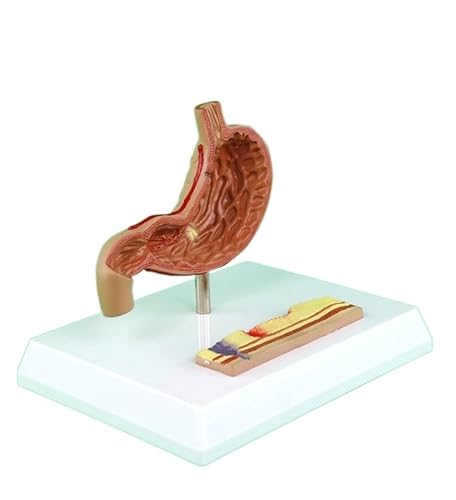 1pc Längsschnitt Von Magen Anatomie Magen Krankheit Demonstration Menschlichen Magen Pathologischen Modell Anatomie Medizinische Versorgung von Huhpa