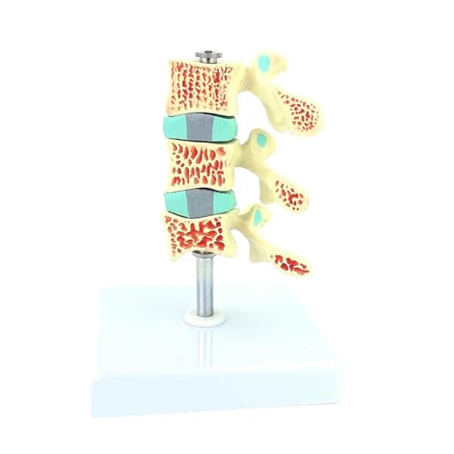 1pc Menschliches Osteoporose Modell Osteoporose Modell Bandscheibe Menschliche Lendenwirbelsäule Modell Orthopädie Schmerzen Abteilung Modell von Huhpa