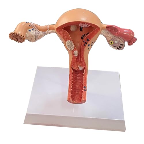 1pc Menschliches Pathologisches Uterus Eierstock Modell Anatomische Anatomie Krankheit Pathologie Medizinische Läsion for Lehre Lernen Medizinische Requisiten von Huhpa