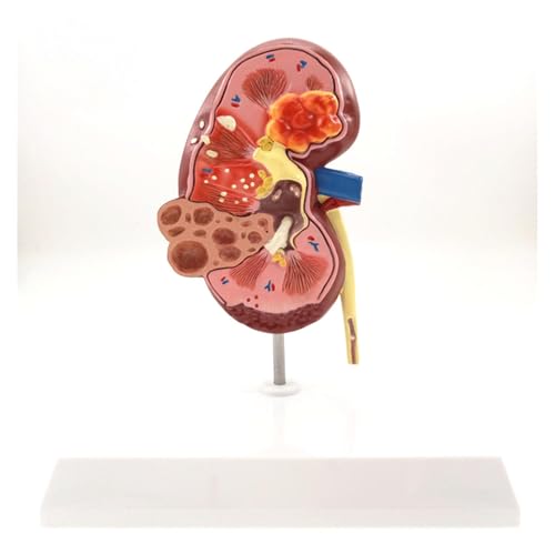 1pc erkrankte Niere Modell menschliche anatomische medizinische pathologische Veränderungen Probe for Patientenaufklärung von Huhpa