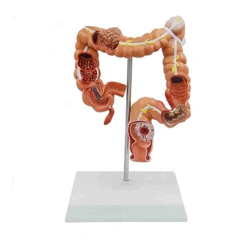 1pc menschliches anatomisch-menschliches Colon-Modell mit Pathologie- und Pathologie-Darmsystem von Huhpa