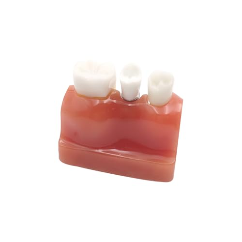 1set Dental Modell 4 Mal Harz Zahn Implantat Modell for Studium Lehrmodul Medizinische Wissenschaft Oral Zahnarzt Zahnmedizin Produkte 1set Dental Modell 4 Mal Harz Zahn Implantat Modell for Studium Lehrmodul Medizinische Wissenschaft Oral Zahnarzt Zahnmedizin Produkte von Huhpa