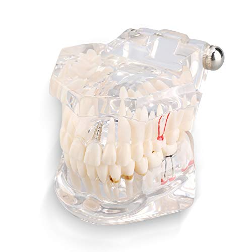 Jadeshay Zahn Modell - Zahnerkrankungen - Lehrstudie für Erwachsene Typodont Demonstrationszähne Neu von Jadeshay