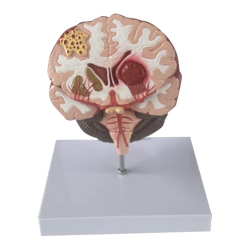 KEALBAUS Modell der menschlichen Hirnkrankheit – Gehirnpathologie, Hirnstammblutung, Lehrmodell – Anatomie-Modell des menschlichen Gehirns KEALBAUS Modell der menschlichen Hirnkrankheit – Gehirnpathologie, Hirnstammblutung, Lehrmodell – Anatomie-Modell des menschlichen Gehirns von KEALBAUS