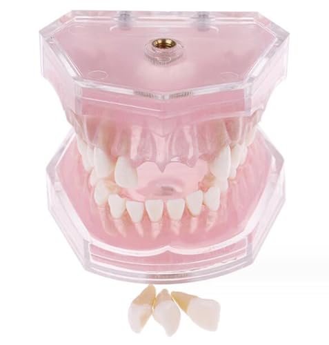 Dental-Modell mit abnehmbaren Zähnen – Standard Soft Tray Ausziehbares Dental-Modell – Ideales Dentallabormaterial Lehrwerkzeug von LKYLVEE