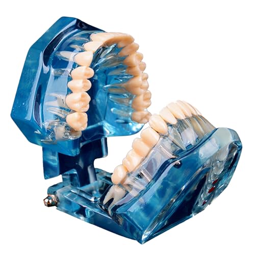 Dental Typodont Modell, Oral Brücke Implantat Modell, für Zähne Brücke Krone Lehren Studium Zahnerziehung (blau) von LKYLVEE