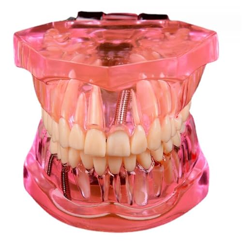 LKYLVEE Dental Typodont Modell, Oral Brücke Implantat Modell, für Zähne Brücke Krone Lehren Studium Zahnerziehung (rot) von LKYLVEE