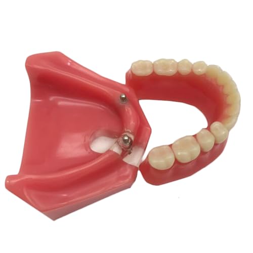Dental Typodont Zähne Modell, Dental Restauration Modell mit 2 Implantaten, für Zahnarzt Lehre Forschung Dental Labor von LKYLVEE