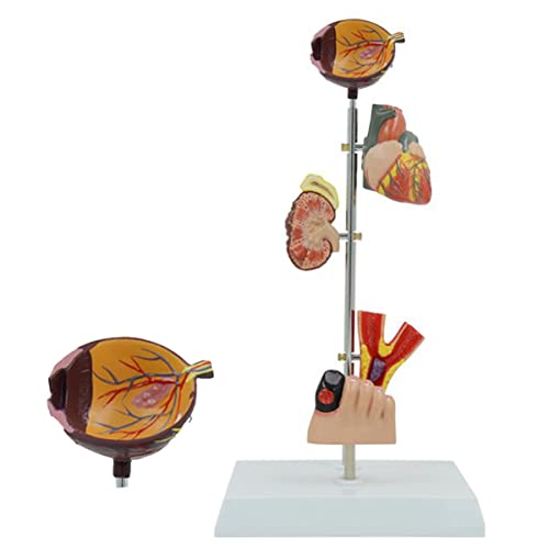 Diabetes-Organmodell, medizinisches anatomisches menschliches Bluthochdruck-Modell, menschliches Organ, Gehirn, Herz und Blutgefäß, Diabetes, Werbungsaktivität, Demonstration, Lehrmittel (B) von LKYLVEE