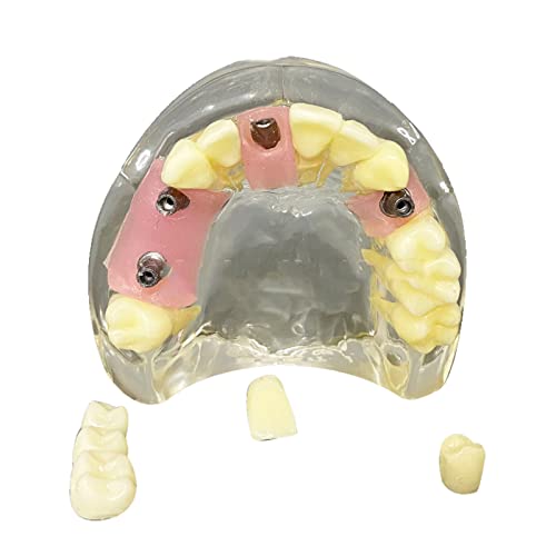 Erwachsene Implantat Zähne Anzeige Modell - Studium Modell Maxillary Dental Implantat Modell - Bildungsmodell Zähne Unterrichtsmodell Abnehmbare Reparatur - für Wissenschaft Demonstration Unterricht Erwachsene Implantat Zähne Anzeige Modell - Studium Modell Maxillary Dental Implantat Modell - Bildungsmodell Zähne Unterrichtsmodell Abnehmbare Reparatur - für Wissenschaft Demonstration Unterricht von LKYLVEE