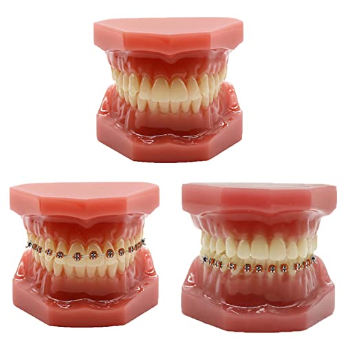 Kieferorthopädisches Zahnmodell – Kieferorthopädische Zahnspangen Zahnmodell – 28-teiliges Keramik-Zahnspangenmodell für Unterrichtspraxis, mit Metall- und Keramikhalterung (Kombination) von LKYLVEE