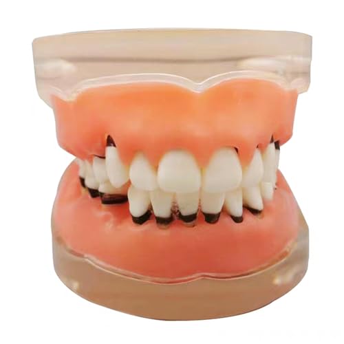 Transparente Zahnstudie Zähne Modell für Parodontopathie Parodontitis Zahnarztpraxis Zähne Kratzen Calculus Modell (weiß) von LKYLVEE
