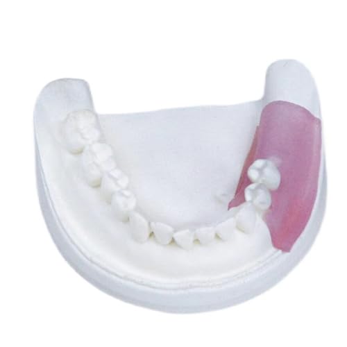 Zahnimplantat Modell, Zahnimplantat Modell für Patientenaufklärung, für Lehre und Studium von LKYLVEE