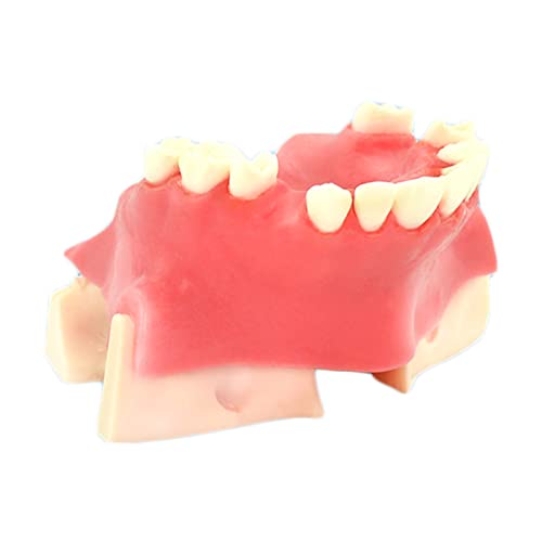 Zahnimplantatmodell – Simulationsmodell der Kieferhöhlenlift-Implantat-Praxis – Simuliertes Zahnpflegemodell Zahnimplantatmodell – für Lehrstudien von LKYLVEE