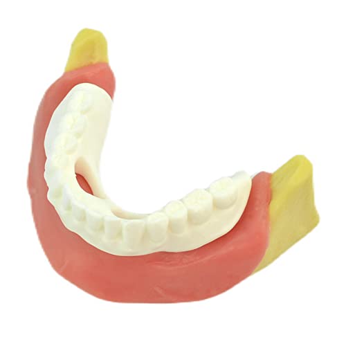 Zahnimplantatmodell – Simuliertes Oralzahn-Lehrmodell – mit Prothesenschale für einfaches Üben und Operationstest – für das Studium der Lehranzeige von LKYLVEE