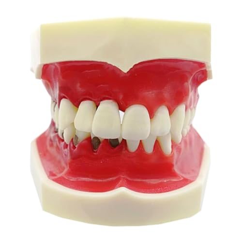 Zahnpathologische Pathologische Parodontitis Zahnmodell - Abnehmbares Gingivae Pathologie Zahnmodell - für Ärzte und Patienten kommunizieren von LKYLVEE