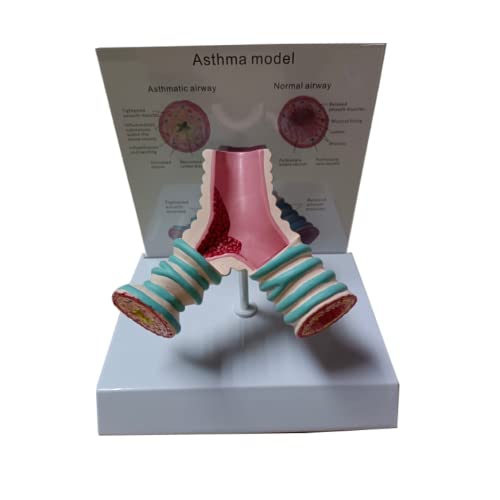 LSOAARRT Asthma-Modell Morbide vergleichende Medizinlehre Arzt-Patienten-Erklärungsmodell LSOAARRT Asthma-Modell Morbide vergleichende Medizinlehre Arzt-Patienten-Erklärungsmodell von LSOAARRT
