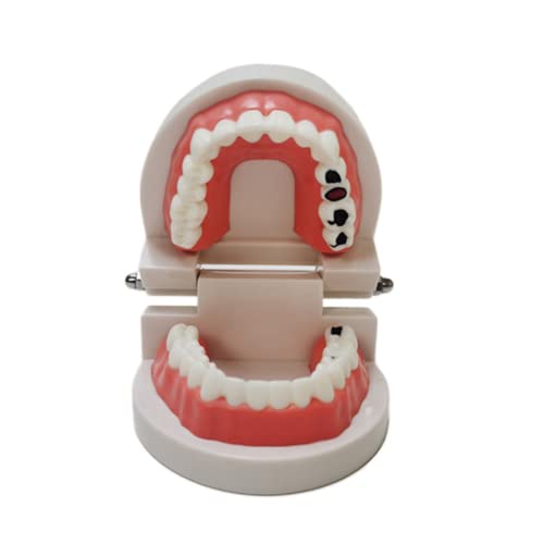 LSOAARRT Dental Study Lehre Zähne Modell Fauler Karies Karies Zahnpflege Lehre Zahnarzt Ausrüstung Zahnersatz von LSOAARRT