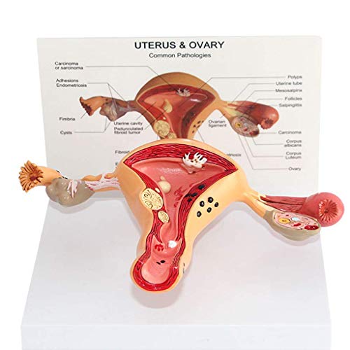 MOLVUS Wissenschaftliches Modell der menschlichen Anatomie, Uterus-Läsionsmodell, anatomisches Wissenschaftsmodell der weiblichen inneren und äußeren Organe, medizinische Organlehrmodelle, für von MOLVUS