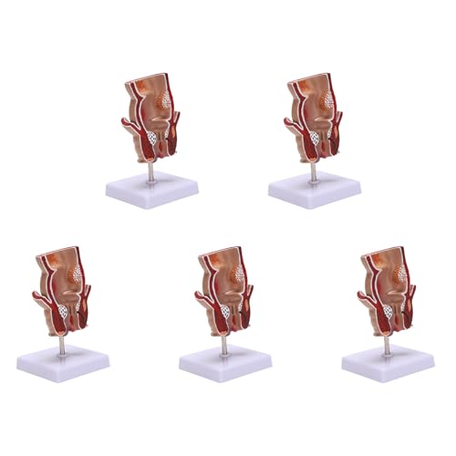 Ohewiiuk 5X Anatomie Modell Menschliches Rektales Hämorrhoiden Läsion Modell Hämorrhoiden Fistel Fistel Fissur Pathologie Lehren Modell von Ohewiiuk