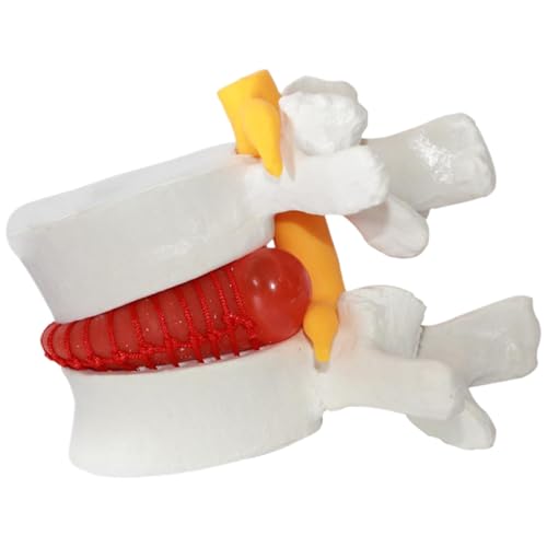 Science -Kits, Herniatd Disc Relief Teachs AIDS, PVC menschliches Körpermodell der Scheibe mit Hernlernlumba -Wirbel, 1,5 -mal lebensgröße Lendenwirbelsäulenmodell zum Lehren, Lernen und Demonstriere Science -Kits, Herniatd Disc Relief Teachs AIDS, PVC menschliches Körpermodell der Scheibe mit Hernlernlumba -Wirbel, 1,5 -mal lebensgröße Lendenwirbelsäulenmodell zum Lehren, Lernen und Demonstriere von Pesoncarl