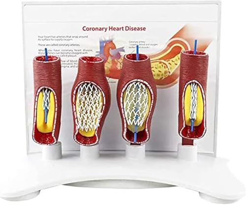 Human Vascular Stent Model - Anatomical Vascular Blockage Demonstration for Healthcare applications Education and Training Human Vascular Stent Model - Anatomical Vascular Blockage Demonstration for Healthcare applications Education and Training von TNGYTY