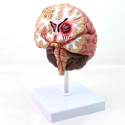 TONZN Anatomiemodell des menschlichen Gehirns Krankheitsmodell des menschlichen Gehirns Gehirnpathologie Gehirnblutung Hirnblutung Forschungsdisplay Lehrtrainingsmodell von TONZN