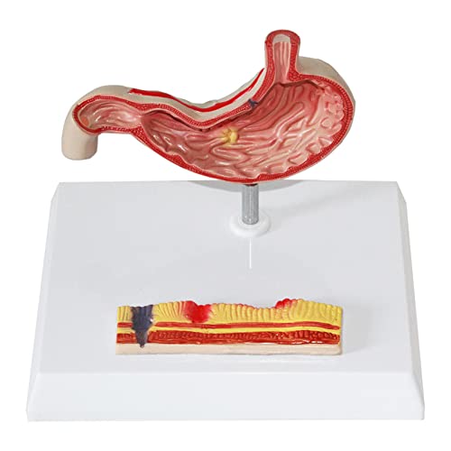 TONZN Menschliche Anatomie Magen, Magen perforiertes Magen-Pathologie-Modell, Magen-Pathologie-Gastritis-Geschwür-Medizin-Lehrwerkzeug von TONZN