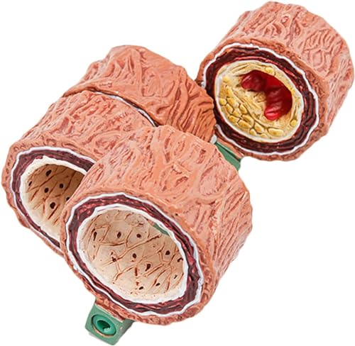 Atherosklerose-Modell, 4-teiliges Arterienmodell – Nachbildung Der Anatomie Des Menschlichen Körpers Einer Arterie Mit Plaque-Ansammlung Zur Demonstration Von Gefäßerkrankungen von VERIMP